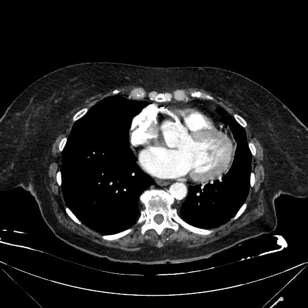 Distal Cholangiocarcinoma (Ung thư biểu mô tế bào gan đoạn xa)