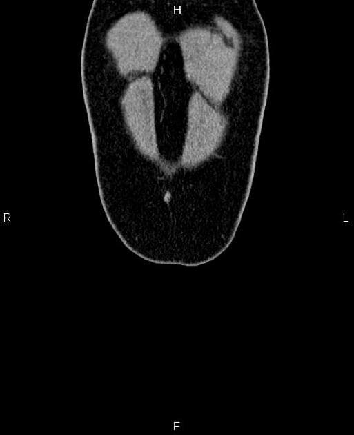 Renal Cystic Mass (Bosniak Class IIF) in an Ectopic Kidney (Khối nang thận (Bosniak class IIF))