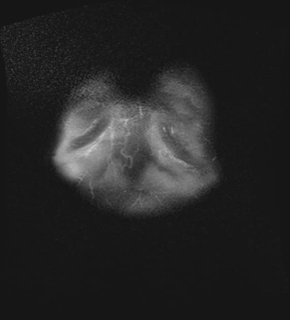 Acute pancreatitis (MRCP)