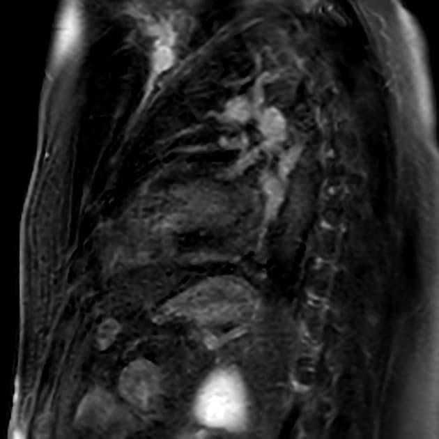 Myocardial inflammation