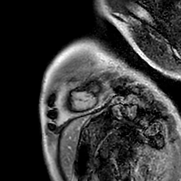 Cardiac amyloidosis - ATTR wild-type