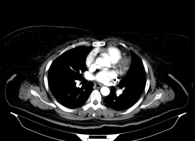 Ruptured hepatic adenoma