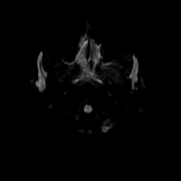 Delayed Posthypoxic Leukoencephalopathy (Bệnh lý thoái hóa trắng sau thiếu oxy chậm)