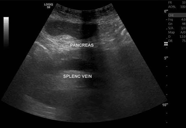 Liver Cirrhosis with Portal Hypertension and Cavernous Transformation (Xơ gan)