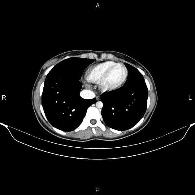 Terminal ileitis due to Crohn disease