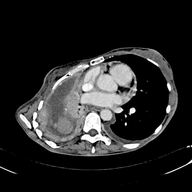 Pericardial Metastasis from Breast and Ovarian Carcinoma (Di căn màng ngoài tim)