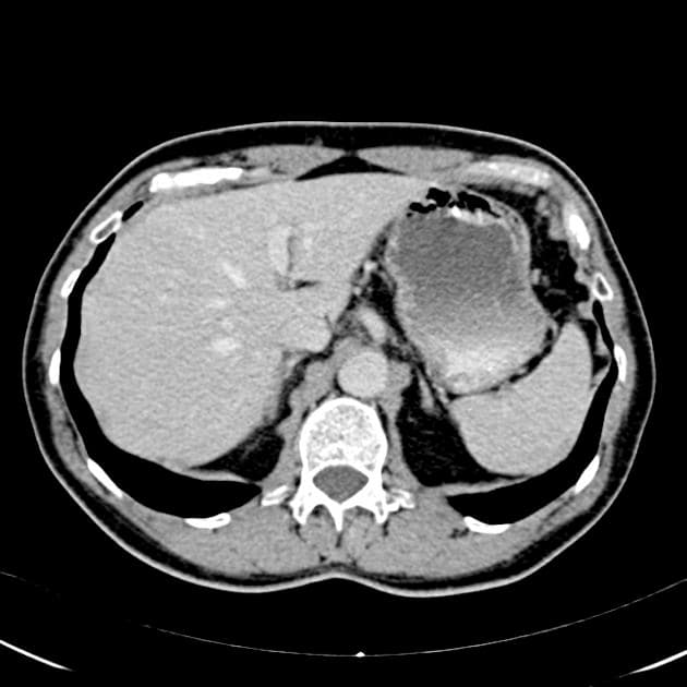Islet-cell tumor of the pancreas (U tế bào đảo tụy)