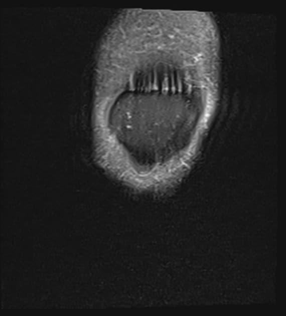 Flipped Meniscus (Tháp mạc gối lật ngược)