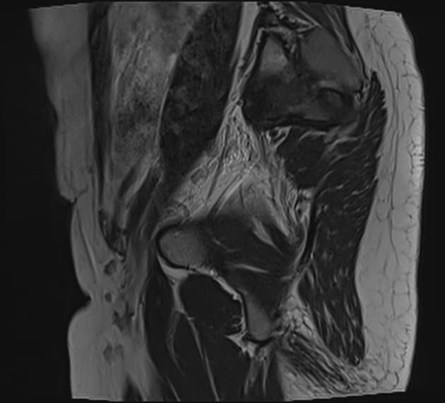 Endometriosis - mushroom cap sign