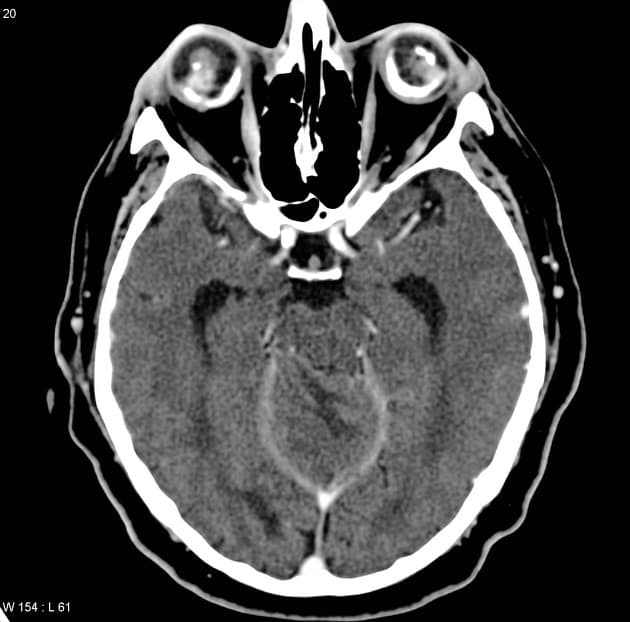 Hemangioblastoma in von Hippel-Lindau Syndrome (U mạch bào – hội chứng von Hippel-Lindau)