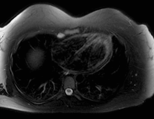 Acute viral hepatitis A