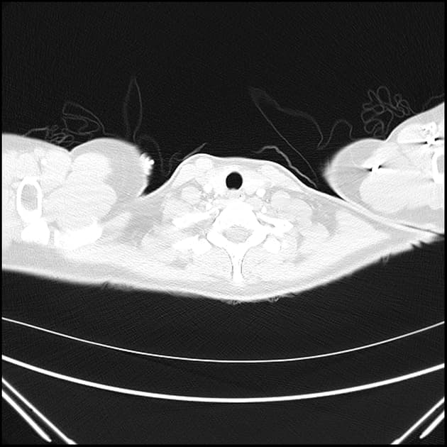Ruptured Renal Angiomyolipoma Causing Pleuritic Chest Pain Diagnosed on CTPA (U nang cơ mỡ thận vỡ gây đau ngực kiểu màng phổi được chẩn đoán trên CTPA)