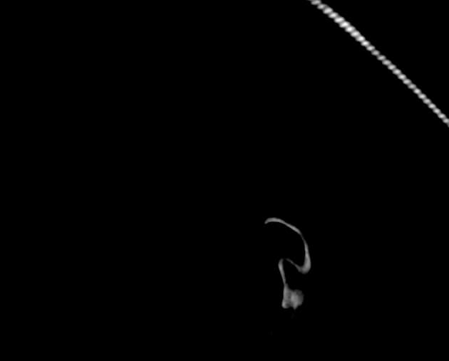 Cerebral Abscesses with Ventriculitis (Áp xe não (cerebral abscesses))