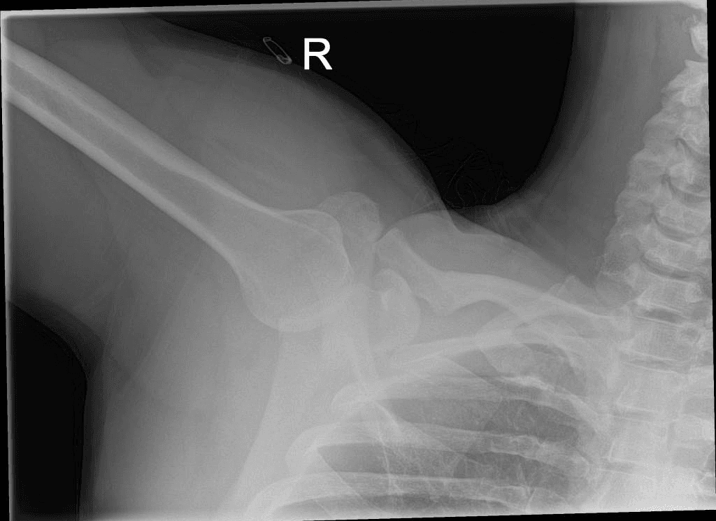 Inferior shoulder dislocation (luxatio erecta)