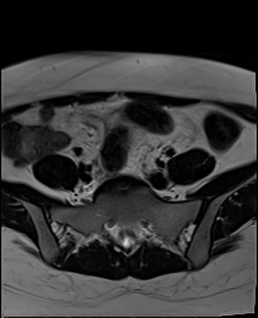 Endometriosis - kissing ovaries sign