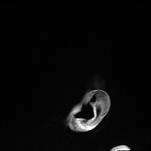 Cerebellar, hippocampal, and basal nuclei transient oedema with restricted diffusion (CHANTER) syndrome