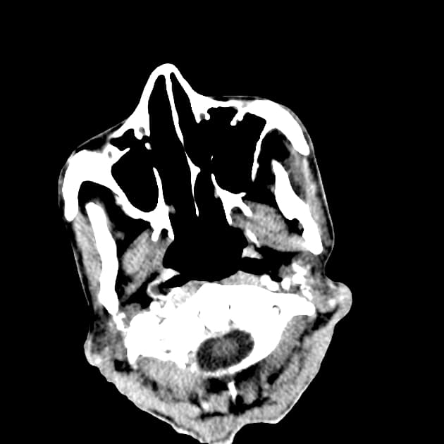 Brain metastases from lung cancer associated with metastasis to the pineal gland