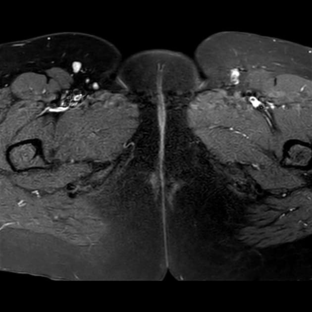 Mushroom sign of deep endometriosis