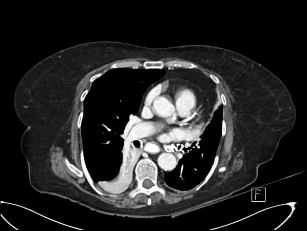 Liver Laceration Due to Laparoscopic Port Insertion (Vết rách gan do chèn dụng cụ nội soi ổ bụng)