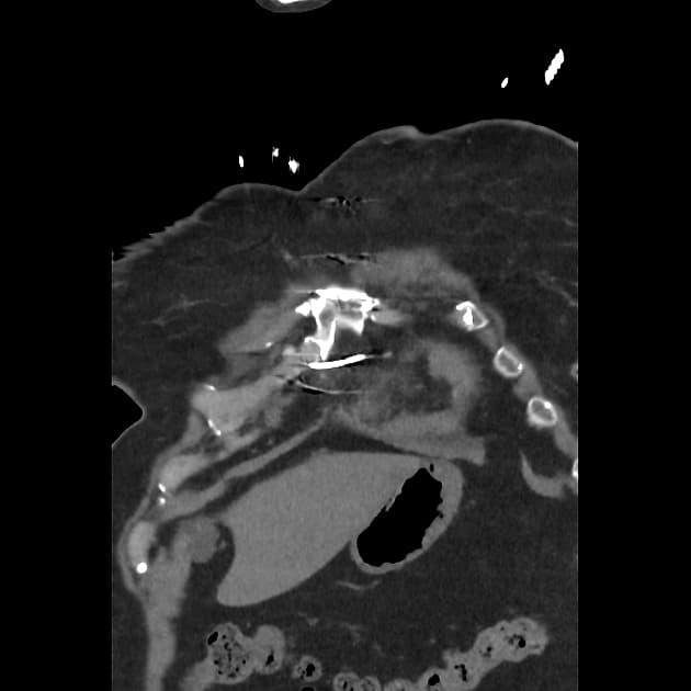 Type A aortic dissection into shared adventitial sheath