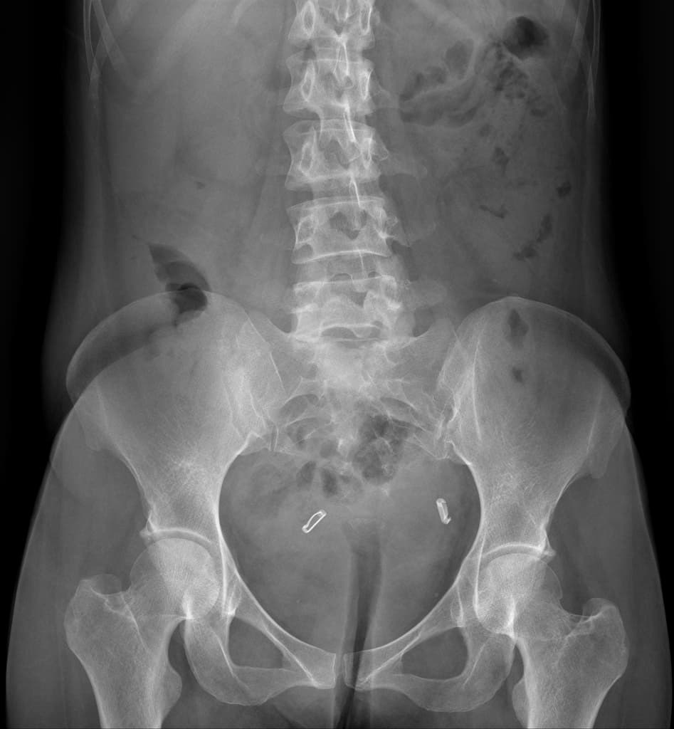 Common bile duct stricture with stones