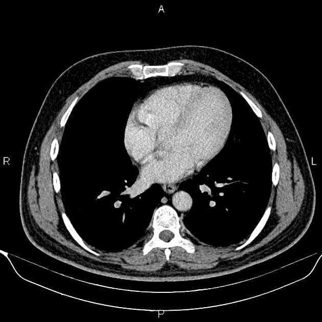Renal Cell Carcinoma with Cystic Changes (Ung thư biểu mô tế bào thận có biến đổi dạng nang)
