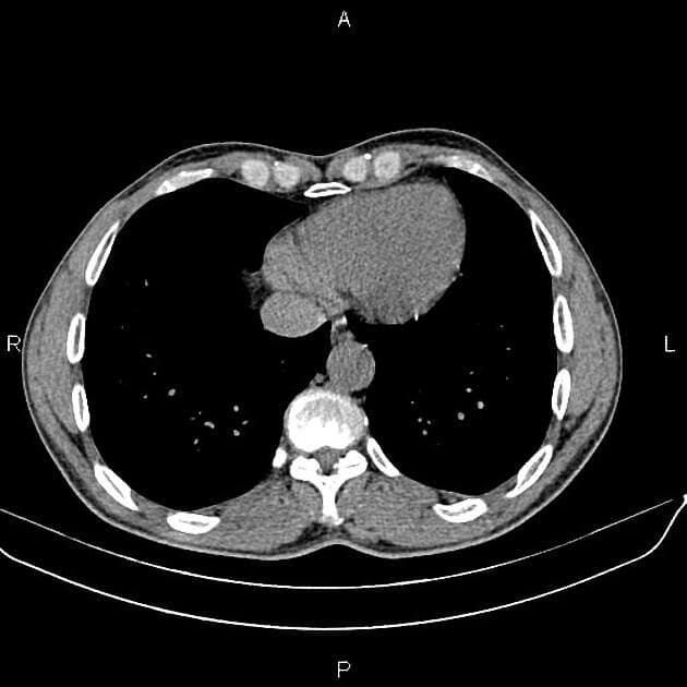 Renal cell carcinoma (stage I) (Ung thư biểu mô tế bào thận (giai đoạn I))