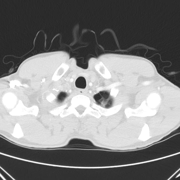 Haemophilus Influenzae Pneumonia with Necrotizing Features (Viêm phổi do Haemophilus)