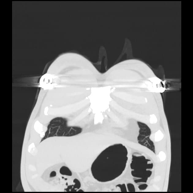 Atypical Pneumonia due to Human Metapneumovirus (Viêm phổi không điển hình – metapneumovirus)