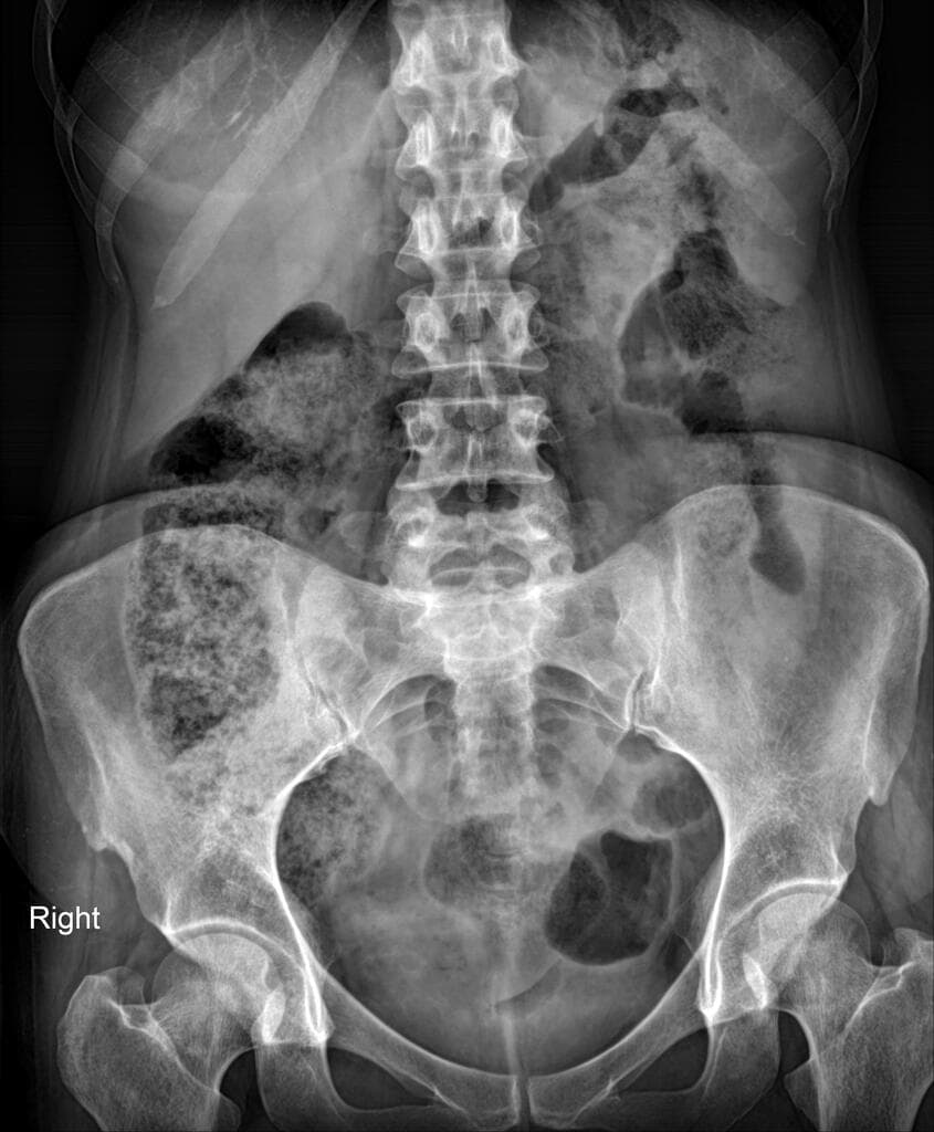 Crohn disease with string sign and rectovaginal fistula