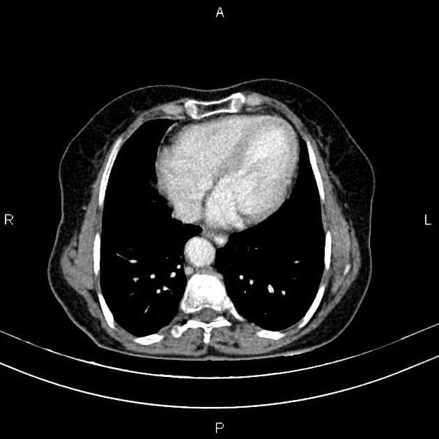 Urothelial Cell Carcinoma of the Urinary Bladder (Ung thư biểu mô đường niệu của bàng quang)