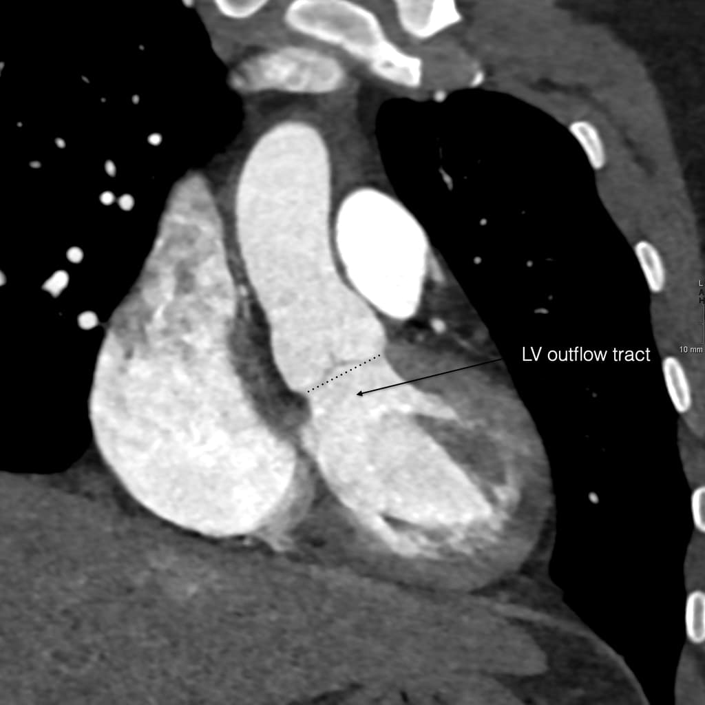 Aortic root anatomy (CTA)