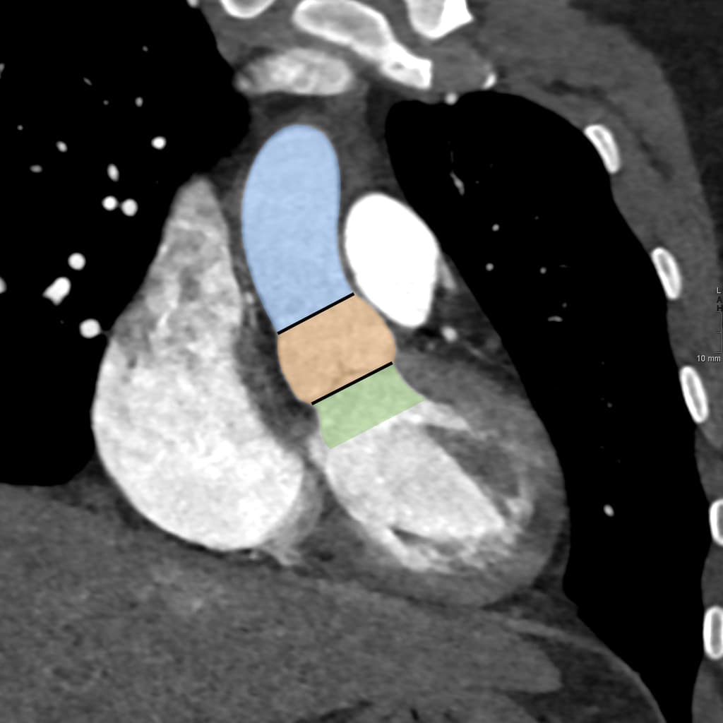 Aortic root anatomy (CTA)