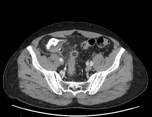 Gangrenous pelvic appendicitis