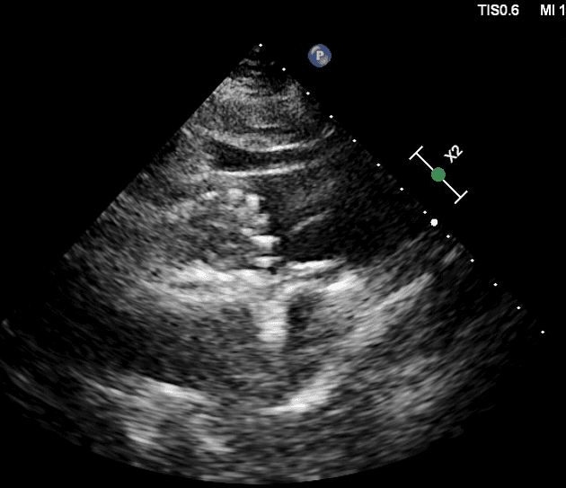 Transcatheter aortic valve implantation (TAVI) echocardiography