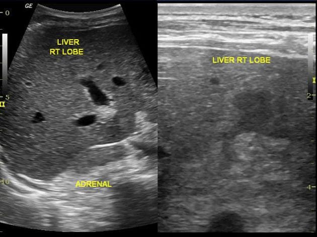 Traumatic Liver Contusion and Right Adrenal Hematoma (Chấn thương gan và tuyến thượng thận)