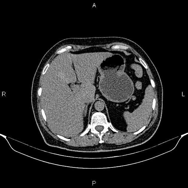 Renal Cystic Mass - Bosniak Class III (Khối nang thận - phân loại Bosniak III)