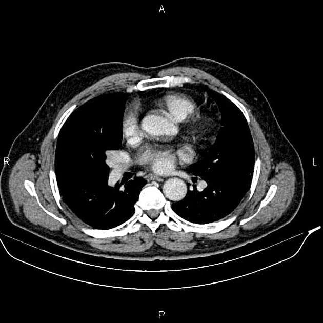 Renal Cell Carcinoma with Dominant Necrotic Changes (Ung thư biểu mô tế bào thận với thay đổi hoại tử chiếm ưu thế)