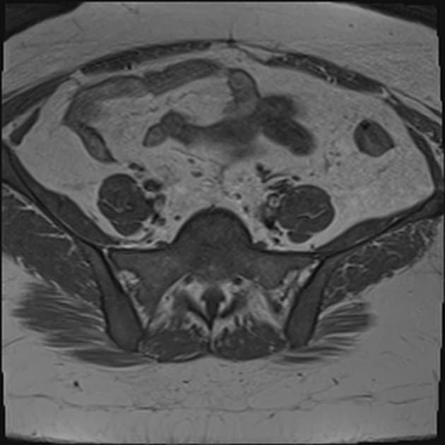 Deep endometriosis - cloverleaf sign