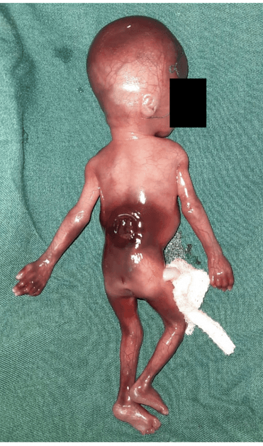 Fetal Open Spina Bifida (Bại liệt tủy sống mở ở thai nhi)