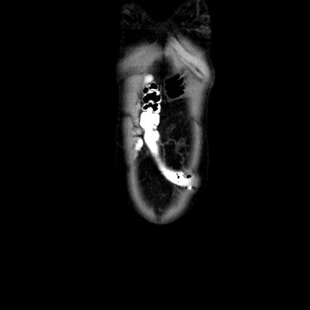 Bilateral Giant Renal Angiomyolipomas in Tuberous Sclerosis (U tuyến cơ mỡ thận hai bên khổng lồ)