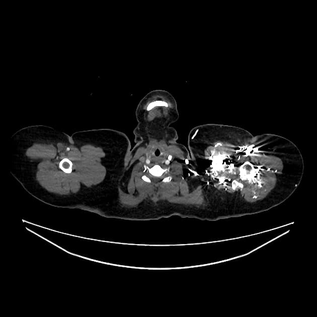 Aortic pseudo-dissection