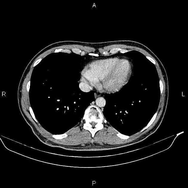 Renal Cell Carcinoma with Cystic Changes (Ung thư biểu mô tế bào thận có biến đổi dạng nang)