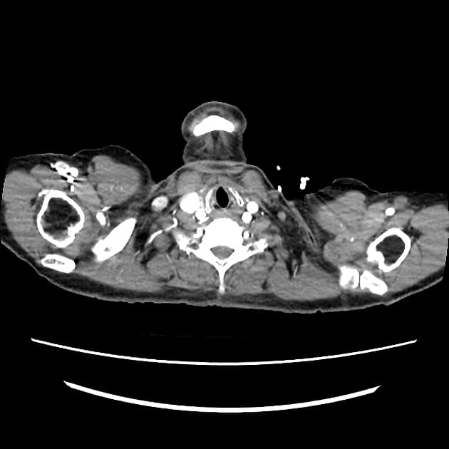 Stanford A aortic dissection