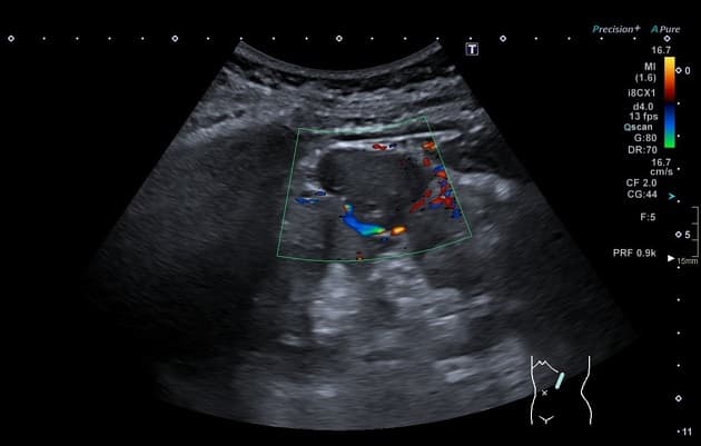 Bosniak Type IV Renal Cyst (U nang thận loại IV theo phân loại Bosniak)