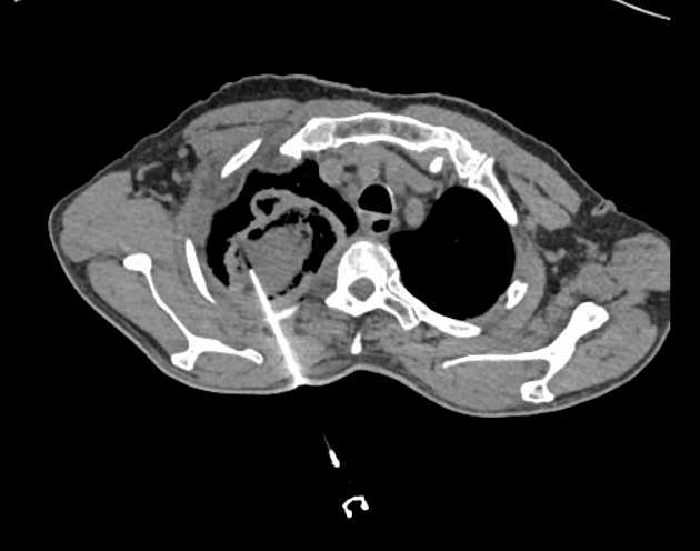 Pulmonary Mucormycosis with Chest Wall and Spinal Invasion (Nhiễm Mucormycosis phổi)