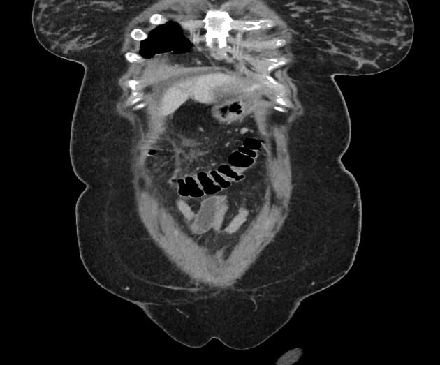 Interstitial edematous pancreatitis