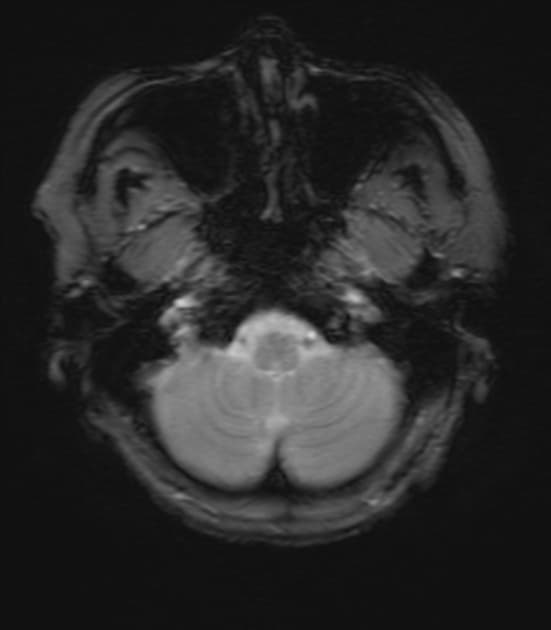 Cerebral Abscess in the Left Temporal Lobe (Áp xe não)