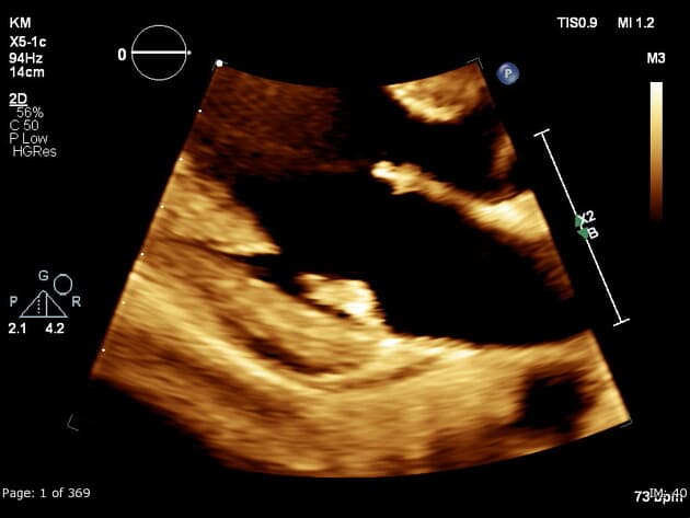 Mitral annular disjunction (MAD)