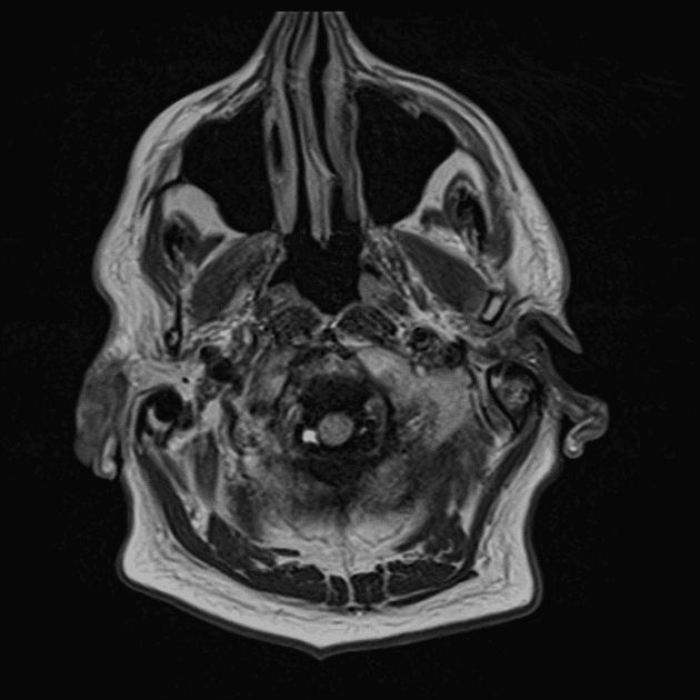 Multiple Sclerosis and Trigeminal Neuralgia with Neurovascular Contact (Xơ cứng rải rác và đau dây thần kinh sinh ba)